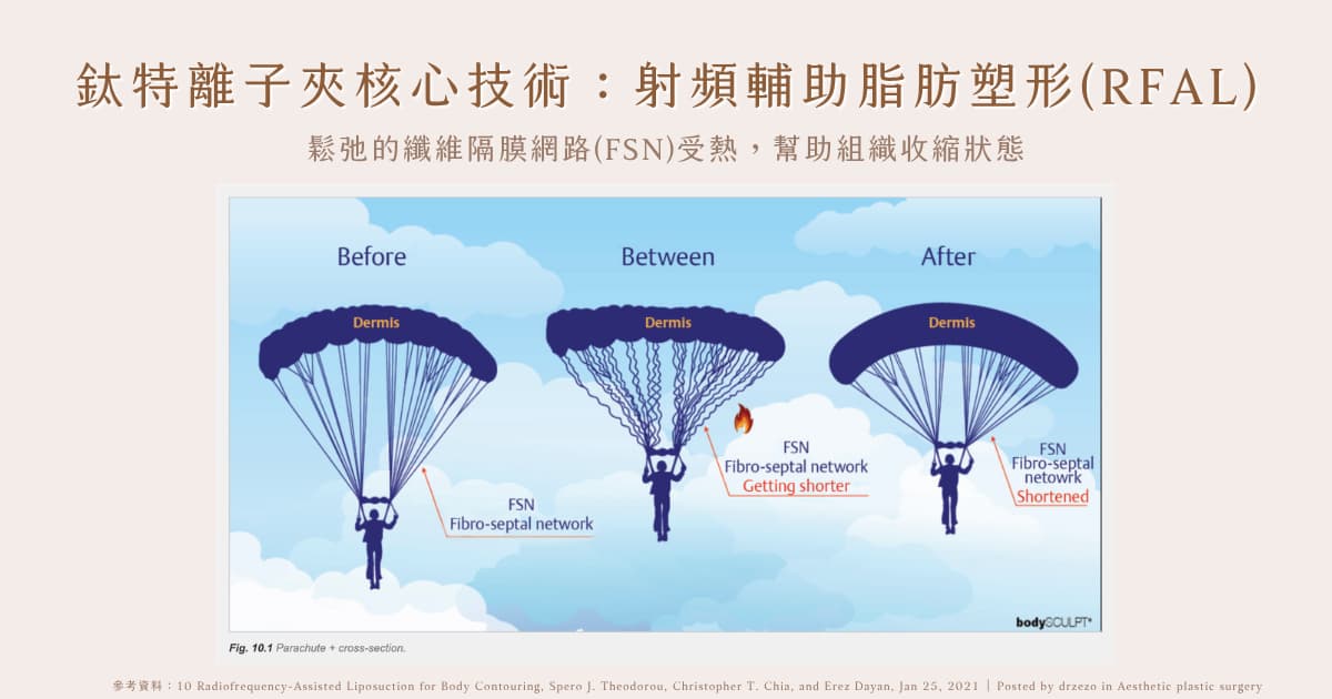 射頻輔助脂肪塑形,RFAL,鈦特,纖維隔膜網路,FSN,賦真妍