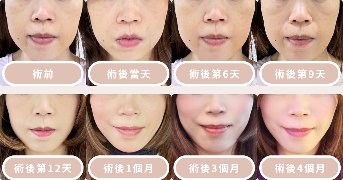 鈦特離子夾,案例,效果,修復期,陳建名醫師,緊緻拉提