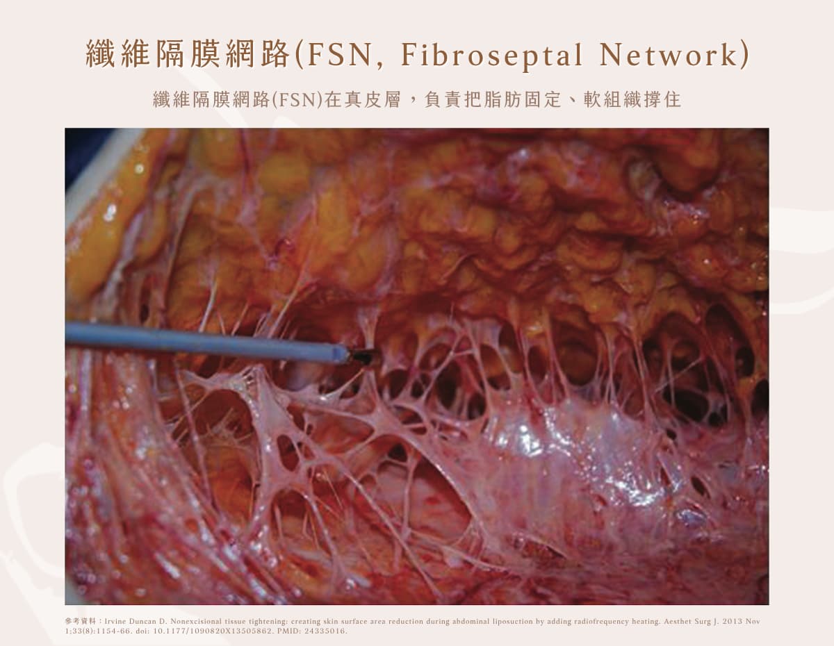 纖維隔膜網路,Fibroseptal Network,FSN,賦真妍,陳建名醫師